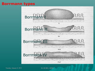 Boreman Classification Carcinoma stomach sb-rubel | PPT