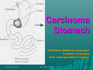 Carcinoma
                        Stomach

                          Professor AMSM Sharfuzzaman
                                    Professor of Surgery
                           Sher-e-Bangla Medical College



January 8, 2013   DR. RUBEL,SBMC                     1
 