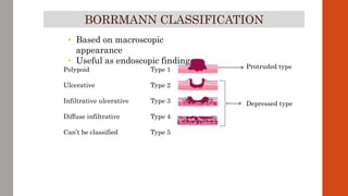 Boreman Classification CARCINOMA STOMACH- ETIOLOGY, CLINICAL FEATURES & INVESTIGATIONS | PPTX