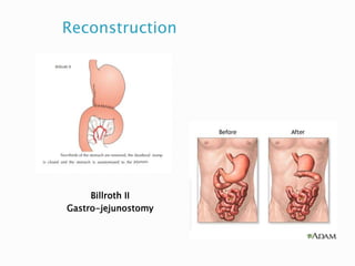 Carcinoma stomach presentation | PPTX