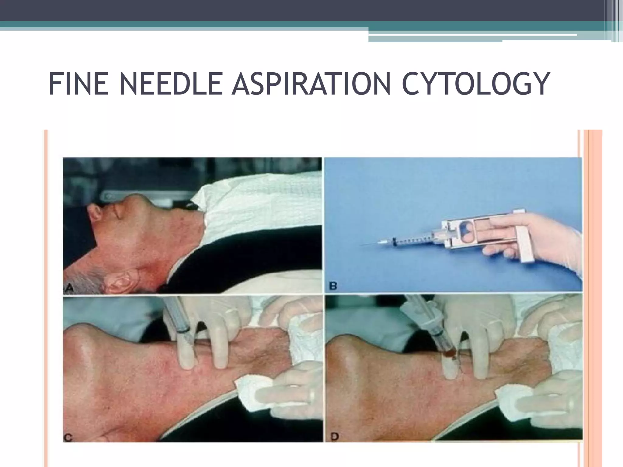 FINE NEEDLE ASPIRATION CYTOLOGY
 