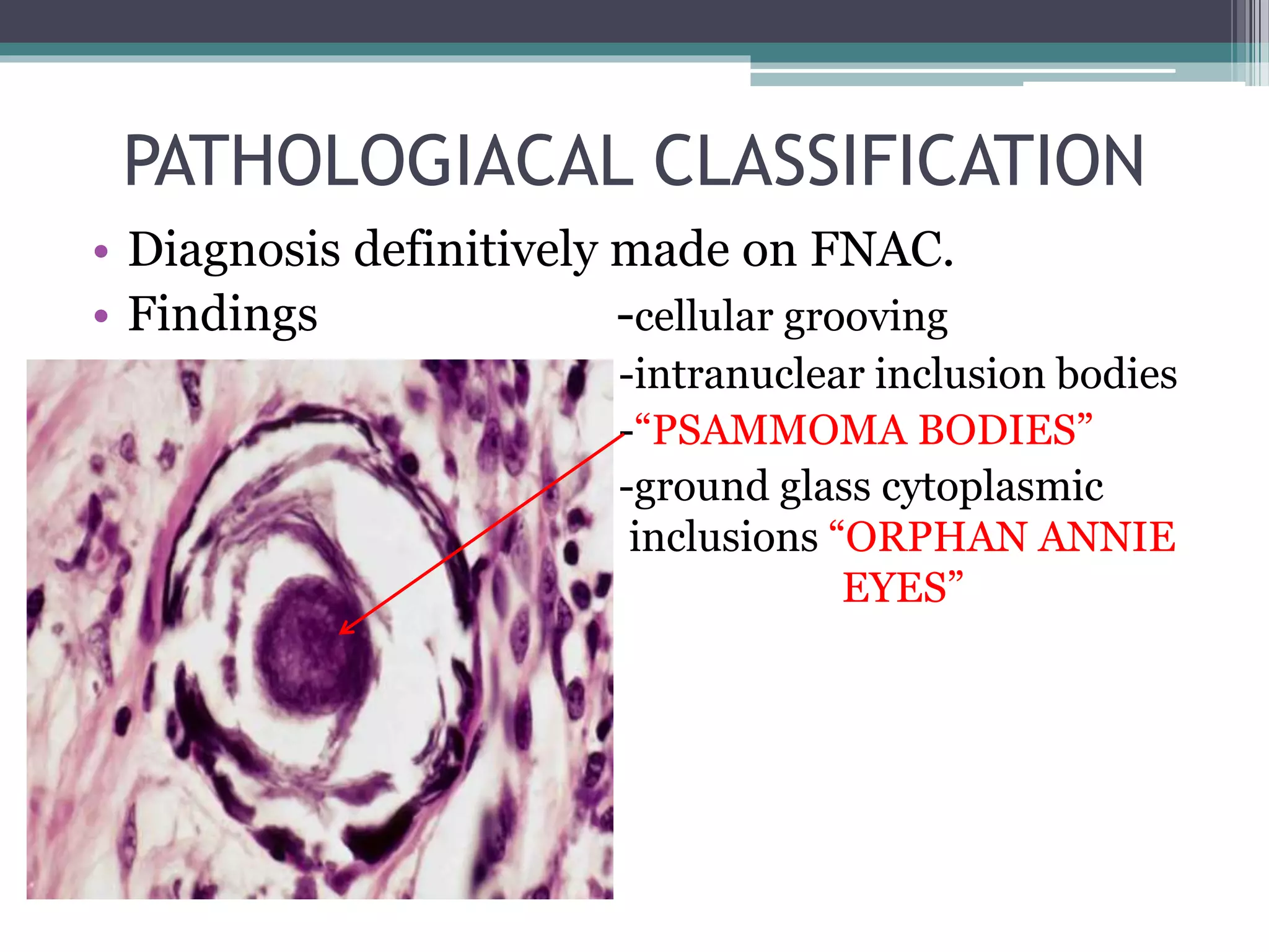 PATHOLOGIACAL CLASSIFICATION
• Diagnosis definitively made on FNAC.
• Findings -cellular grooving
-intranuclear inclusion bodies
-“PSAMMOMA BODIES”
-ground glass cytoplasmic
inclusions “ORPHAN ANNIE
EYES”
 