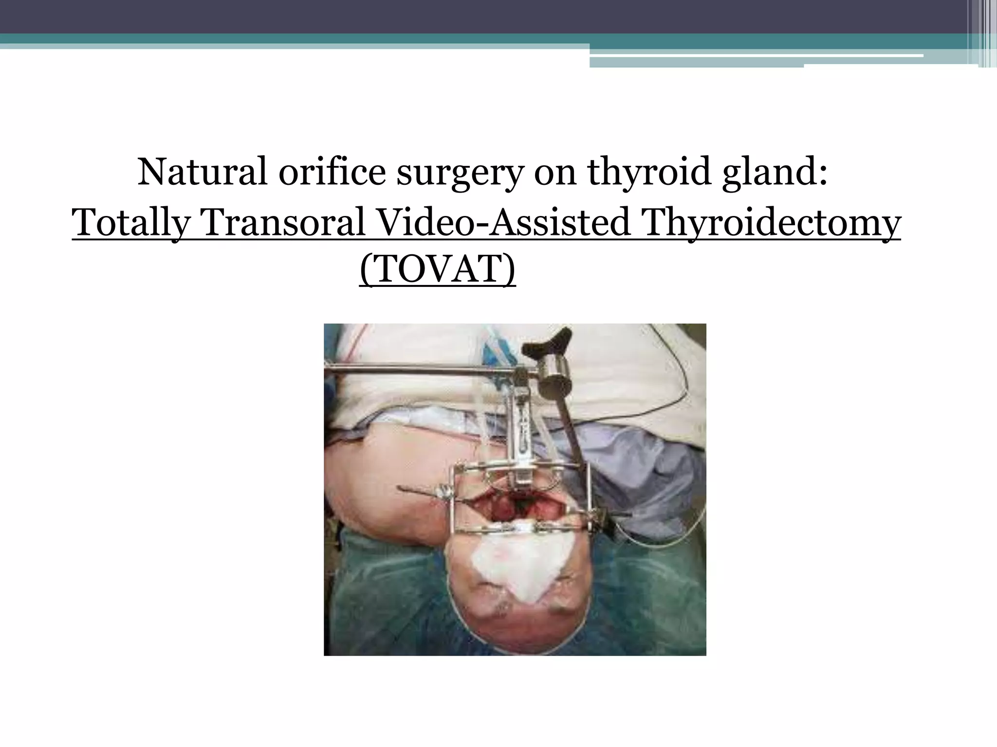 Natural orifice surgery on thyroid gland:
Totally Transoral Video-Assisted Thyroidectomy
(TOVAT)
 