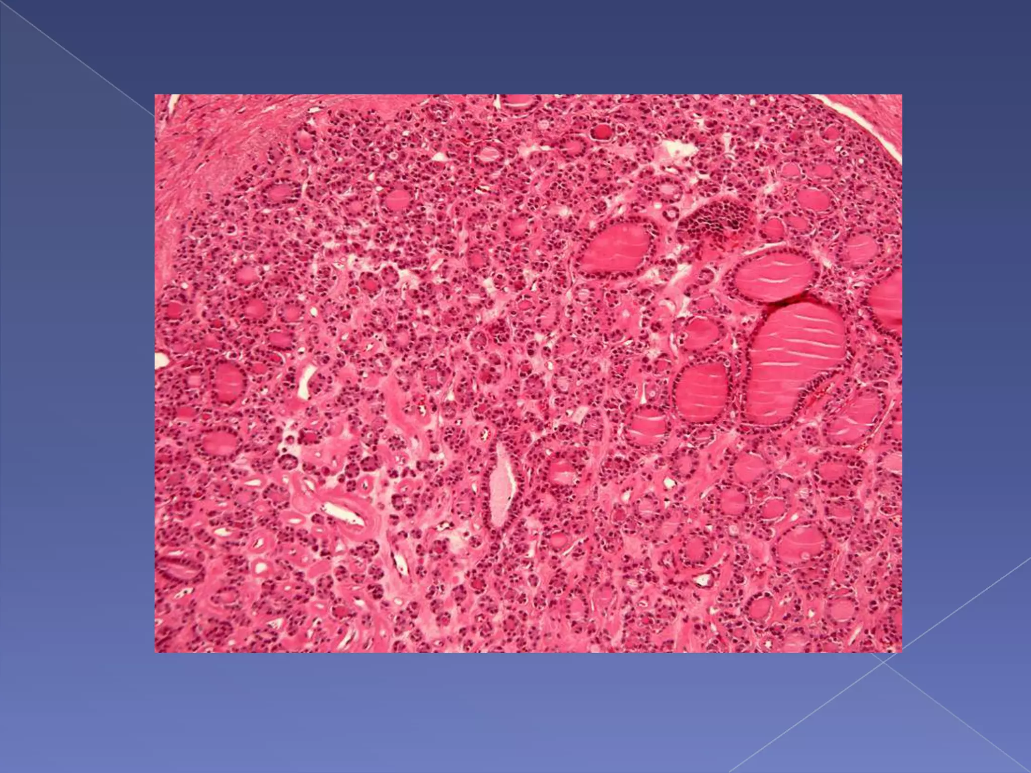 TypesPrimaryFollicular cells (papillary, follicular, and anaplastic)Para-follicular cells (medullary)Lymphocytes (lymphoma)SecondaryMetastasesLocal infiltration