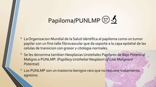 • La Organizacion Mundial de la Salud identifica al papiloma como un tumor
papilar con un fino tallo fibrovascular que da soporte a la capa epitelial de las
celulas de transicion con grosor y citologia normales.
• Se les denomina tambien Neoplasias Uroteliales Papilares de Bajo Potencial
Maligno o PUNLMP. (Papillary Urothelial Neoplasm of Low Malignant
Potential)
• Los PUNLMP son un trastorno benigno raro que no requiere tratamiento
agresivo.
Papiloma/PUNLMP 😒🔬
 