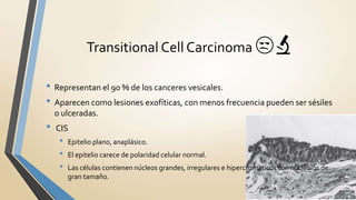 • Representan el 90 % de los canceres vesicales.
• Aparecen como lesiones exofíticas, con menos frecuencia pueden ser sésiles
o ulceradas.
• CIS
• Epitelio plano, anaplásico.
• El epitelio carece de polaridad celular normal.
• Las células contienen núcleos grandes, irregulares e hipercromaticos con nucléolos de
gran tamaño.
Transitional Cell Carcinoma 😒🔬
 