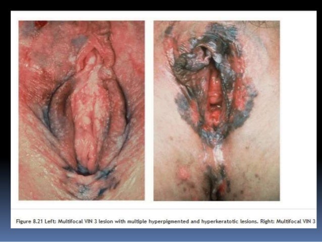 Midget world title stardome Pictures of vulva carcinoma