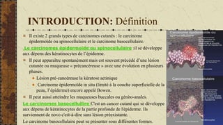 INTRODUCTION: Définition
Il existe 2 grands types de carcinomes cutanés : le carcinome
épidermoïde ou spinocellulaire et le carcinome basocellulaire.
Le carcinomes épidermoïde ou spinocellulaire :il se développe
aux dépens des kératinocytes de l’épiderme.
Il peut apparaître spontanément mais est souvent précédé d’une lésion
cutanée ou muqueuse « précancéreuse » avec une évolution en plusieurs
phases.
Lésion pré-cancéreuse la kératose actinique
Carcinome épidermoïde in situ (limité à la couche superficielle de la
peau, l’épiderme) encore appelé Bowen.
Il peut aussi atteindre les muqueuses buccales ou génito-anales.
Le carcinomes basocellullire C'est un cancer cutané qui se développe
aux dépens de kératinocytes de la partie profonde de l'épiderme. Ils
surviennent de novo c'est-à-dire sans lésion préexistante.
Le carcinome basocellulaire peut se présenter sous différentes formes.
 