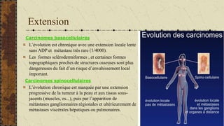 Extension
Carcinomes basocellulaires
L’évolution est chronique avec une extension locale lente
sans ADP et métastase très ...