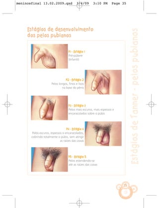 meninosfinal 13.02.2009.qxd                3/4/09       3:10 PM       Page 35




     Estágios de desenvolvimento




                                                                                Estágios de Tanner - pelos pubianos
     dos pelos pubianos


                                     P1 - Estágio 1
                                     Pré-púbere
                                     (Infantil)




                                   P2 - Estágio 2
                       Pelos longos, finos e lisos
                                na base do pênis




                                     P3 - Estágio 3
                                     Pelos mais escuros, mais espessos e
                                     encaracolados sobre o púbis




                                   P4 - Estágio 4
       Pelos escuros, espessos e encaracolados,
       cobrindo totalmente o púbis, sem atingir
                             as raízes das coxas




                                     P5 - Estágio 5
                                     Pelos estendendo-se
                                     até as raízes das coxas




                                                                           35
 