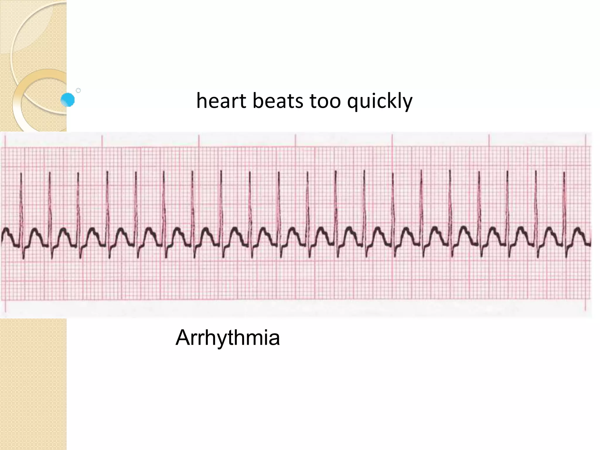 Arrhythmia
heart beats too quickly
 