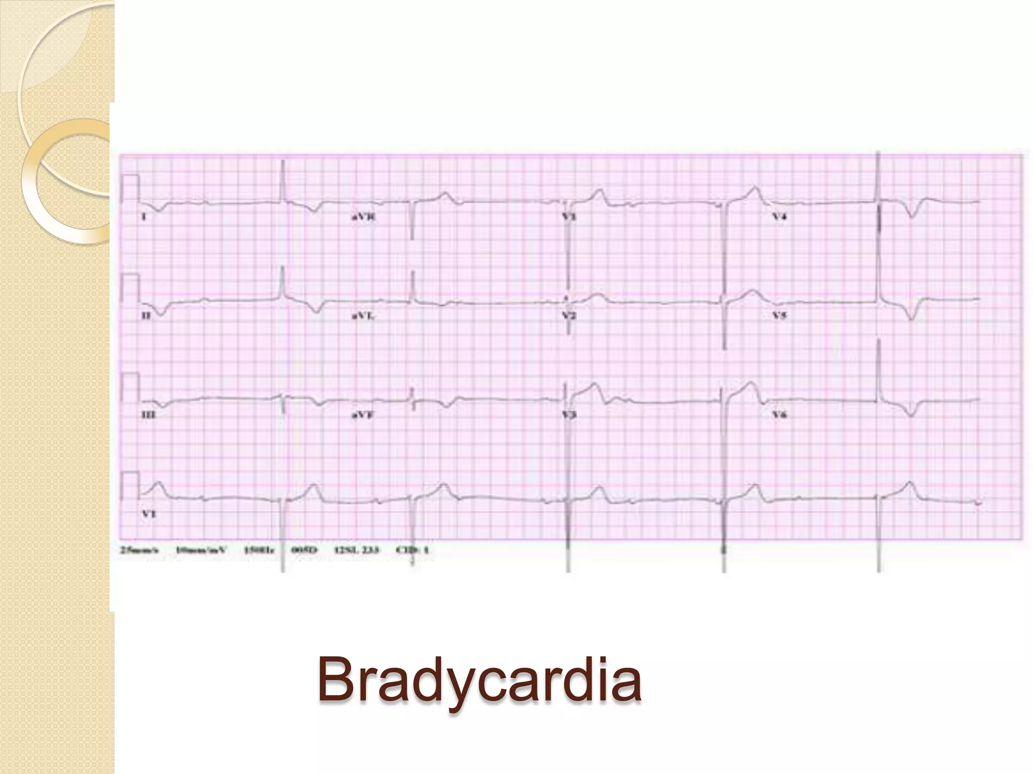 Bradycardia
 
