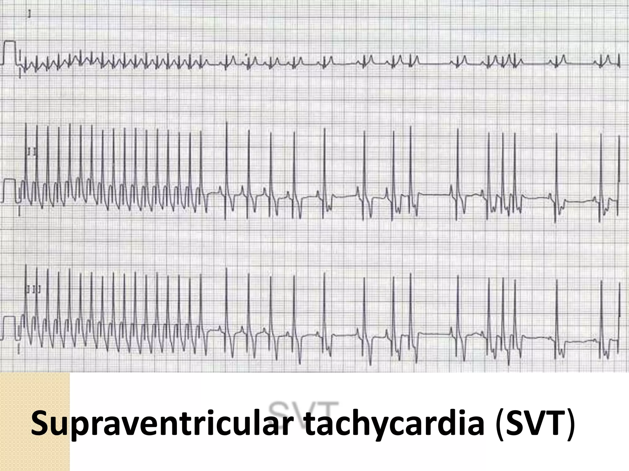 Supraventricular tachycardia (SVT)
 