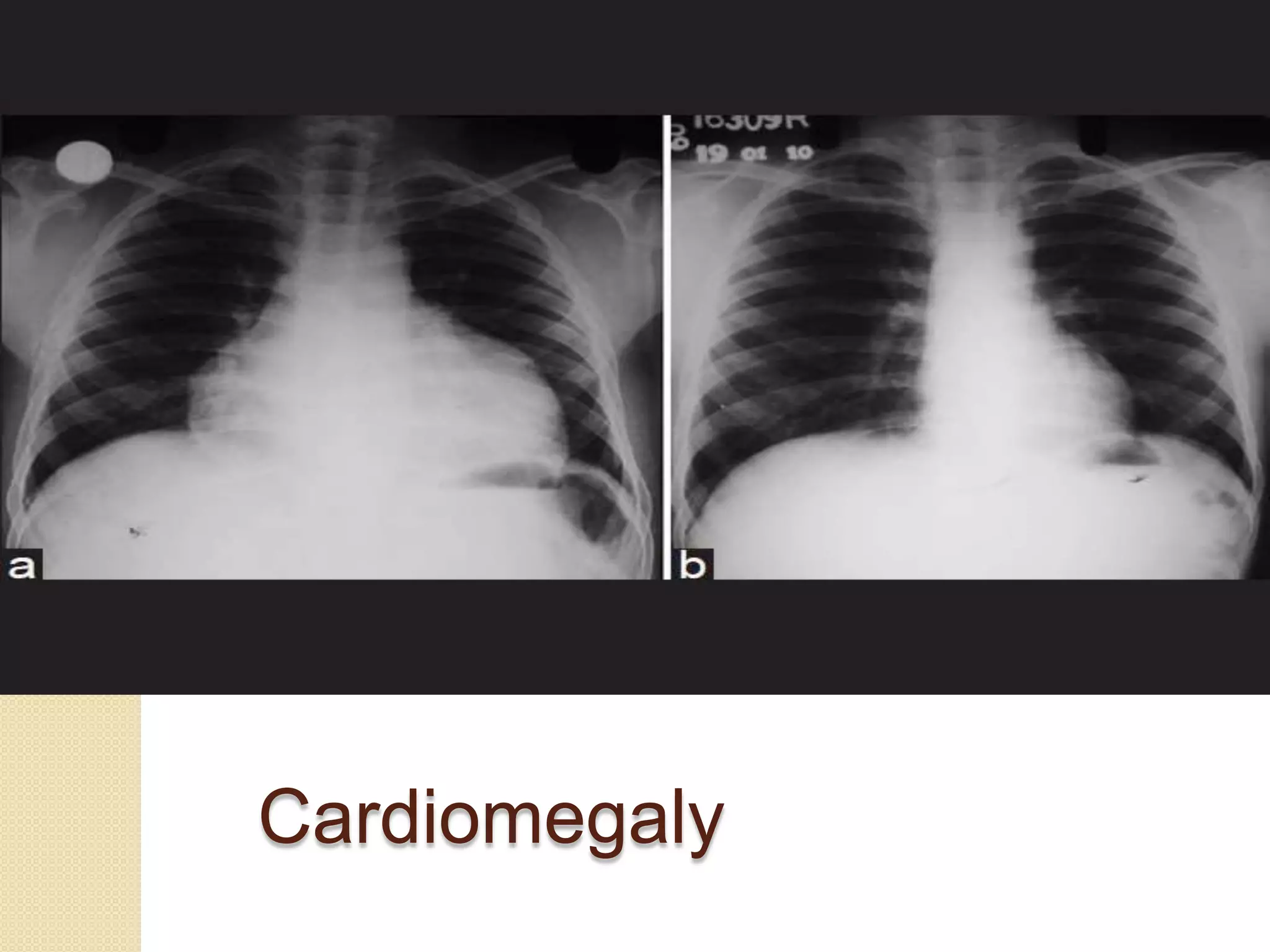 Cardiomegaly
 