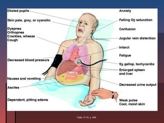 Congestive Heart Failure Table 17-10. p. 548. 