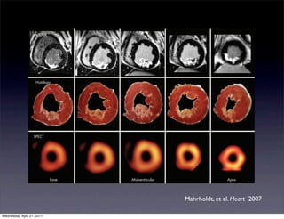 Downloaded from heart.bmj.com on October 25, 2010 - Published by group.bmj.com


                                                                                                                                             EDUCATION IN HEART



                   ce CMR




    124


                    Histology




                   SPECT




                             Base                                                   Midventricular                                                 Apex


             Figure 2 Contrast enhanced cardiovascular magnetic resonance (CeCMR), histology and single photon emission computed tomography (SPECT) images
             obtained in an animal with a medium sized infarct. There is a nearly perfect match between necrosis defined by histology and ceCMR. Whereas ceCMR
                                                                                                                       Mahrholdt, et al. Heart 2007
             allows the exact assessment of the transmural extent of infarction, SPECT defines segments as either viable or non-viable. Reproduced with permission from
             Wagner et al.9


Wednesday, April 27, 2011
 