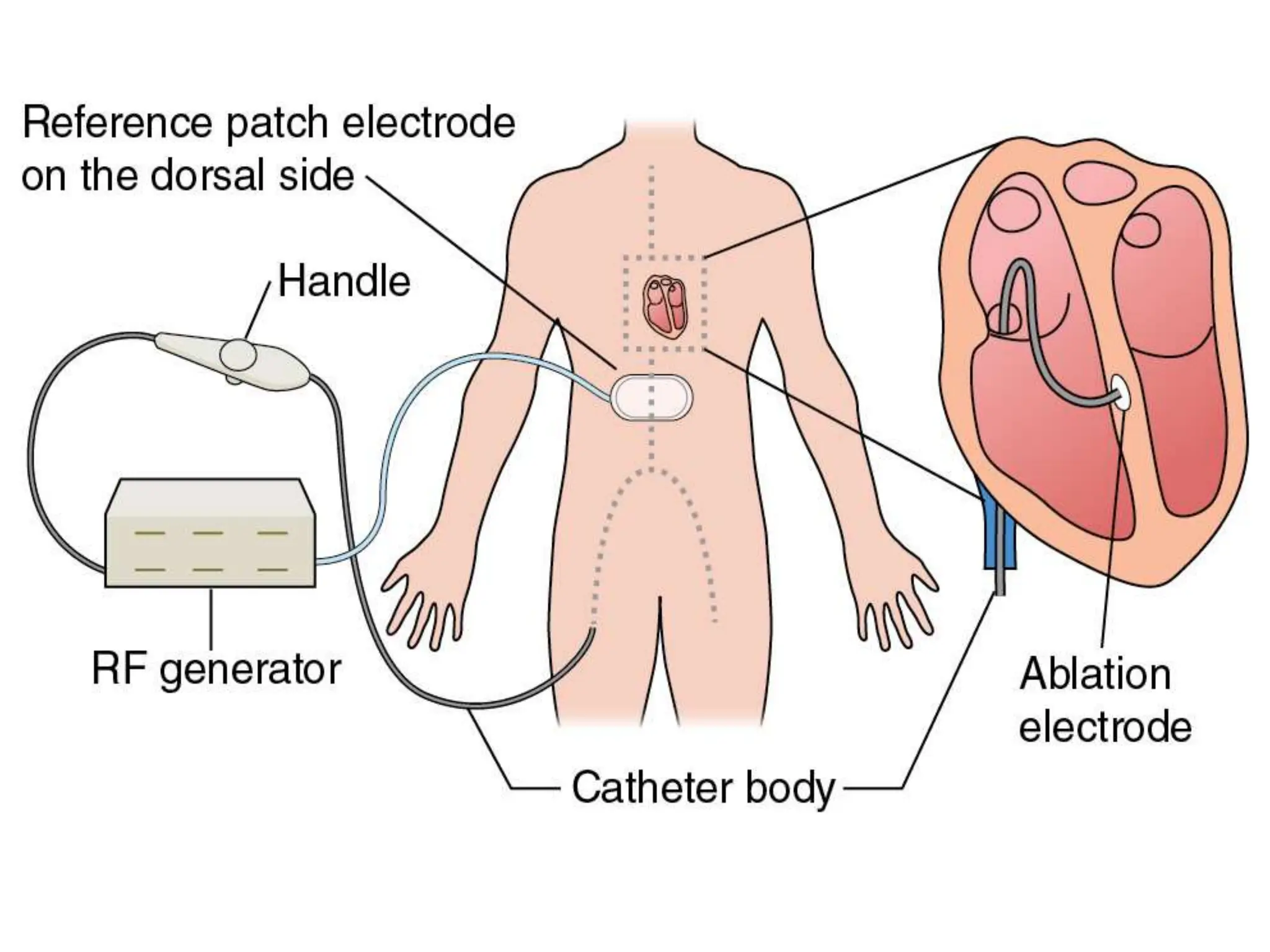 Cardiac Ablation Catheter used in cardiac systems | PPT