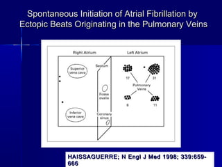 Spontaneous Initiation of Atrial Fibrillation bySpontaneous Initiation of Atrial Fibrillation by
Ectopic Beats Originating in the Pulmonary VeinsEctopic Beats Originating in the Pulmonary Veins
HAISSAGUERRE; N Engl J Med 1998; 339:659-HAISSAGUERRE; N Engl J Med 1998; 339:659-
666666
 