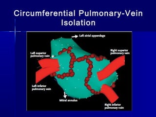 Circumferential Pulmonary-Vein
Isolation
 