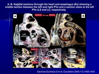A, B, Sagittal sections through the heart and esophagus (Es) showing a
middle section between the left and right PVs and a section close to the left
PVs (LS and LI), respectively.
Sánchez-Quintana D et al. Circulation 2005;112:1400-1405
RIPVRIPV
LIPVLIPV
 