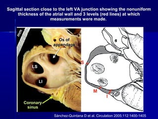 Sagittal section close to the left VA junction showing the nonuniform
thickness of the atrial wall and 3 levels (red lines) at which
measurements were made.
Sánchez-Quintana D et al. Circulation 2005;112:1400-1405
 