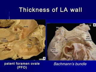 Thickness of LA wallThickness of LA wall
Bachmann’s bundlepatent foramen ovalepatent foramen ovale
(PFO)(PFO)
 