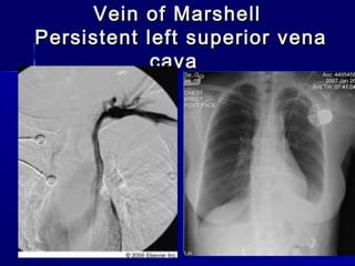Vein of MarshellVein of Marshell
Persistent left superior venaPersistent left superior vena
cavacava
 