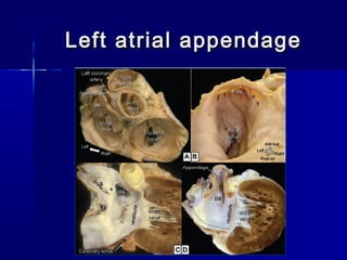Left atrial appendageLeft atrial appendage
 