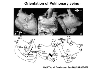 Ho S Y et al. Cardiovasc Res 2002;54:325-336
Orientation of Pulmonary veins
 