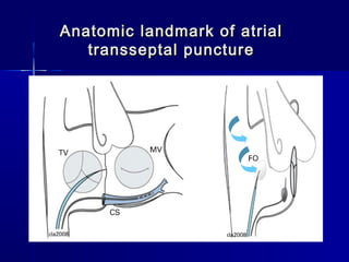 Anatomic landmark of atrialAnatomic landmark of atrial
transseptal puncturetransseptal puncture
 