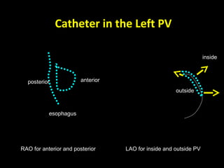 Catheter in the Left PV
esophagus
anteriorposterior
inside
outside
RAO for anterior and posterior LAO for inside and outside PV
 