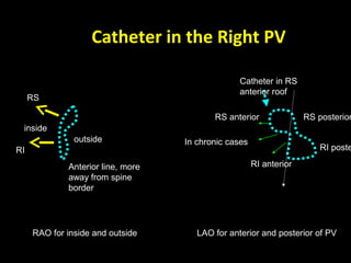 Catheter in the Right PV
inside
outside
RS
RI
Anterior line, more
away from spine
border
RS anterior RS posterior
RI anterior
RI poste
In chronic cases
Catheter in RS
anterior roof
RAO for inside and outside LAO for anterior and posterior of PV
 
