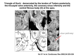 Triangle of Koch: demarcated by the tendon of Todaro posteriorly,
the tricuspid valve anteriorly, the coronary sinus inferiorly and the
central fibrous body (O) at the apex.
Ho S Y et al. Cardiovasc Res 2002;54:325-336
slow pathwayslow pathway
 