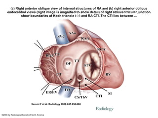 (a) Right anterior oblique view of internal structures of RA and (b) right anterior oblique
endocardial views (right image is magnified to show detail) of right atrioventricular junction
show boundaries of Koch triangle ( ) and RA CTI. The CTI lies between ...☆
Saremi F et al. Radiology 2008;247:658-668
©2008 by Radiological Society of North America
 