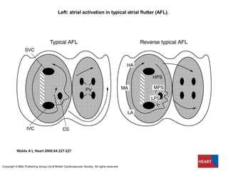 Left: atrial activation in typical atrial flutter (AFL).
Waldo A L Heart 2000;84:227-227
Copyright © BMJ Publishing Group Ltd & British Cardiovascular Society. All rights reserved.
 
