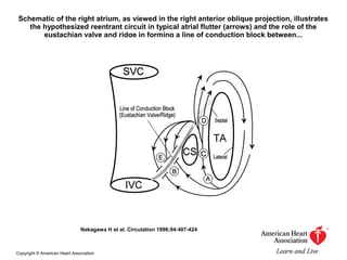 Schematic of the right atrium, as viewed in the right anterior oblique projection, illustrates
the hypothesized reentrant circuit in typical atrial flutter (arrows) and the role of the
eustachian valve and ridge in forming a line of conduction block between...
Nakagawa H et al. Circulation 1996;94:407-424
Copyright © American Heart Association
 