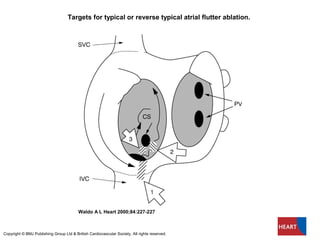 Targets for typical or reverse typical atrial flutter ablation.
Waldo A L Heart 2000;84:227-227
Copyright © BMJ Publishing Group Ltd & British Cardiovascular Society. All rights reserved.
 
