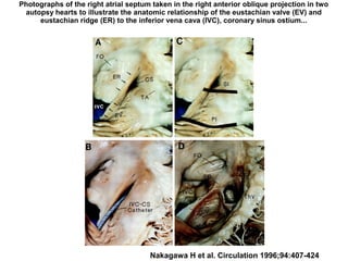 Photographs of the right atrial septum taken in the right anterior oblique projection in two
autopsy hearts to illustrate the anatomic relationship of the eustachian valve (EV) and
eustachian ridge (ER) to the inferior vena cava (IVC), coronary sinus ostium...
Nakagawa H et al. Circulation 1996;94:407-424
 