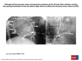 Orthogonal fluoroscopic views showing the positions of the 20 pole Halo catheter and the
two pacing electrodes at the low lateral right atrium (LLRA) and coronary sinus ostium (CSO).
Lin J et al. Heart 1999;81:73-81
Copyright © BMJ Publishing Group Ltd & British Cardiovascular Society. All rights reserved.
 