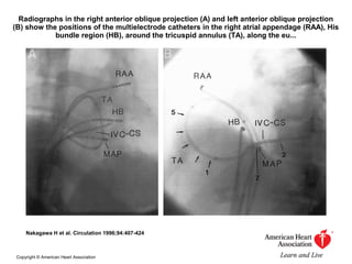 Radiographs in the right anterior oblique projection (A) and left anterior oblique projection
(B) show the positions of the multielectrode catheters in the right atrial appendage (RAA), His
bundle region (HB), around the tricuspid annulus (TA), along the eu...
Nakagawa H et al. Circulation 1996;94:407-424
Copyright © American Heart Association
 