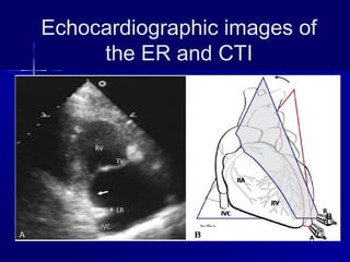 Echocardiographic images of
the ER and CTI
 