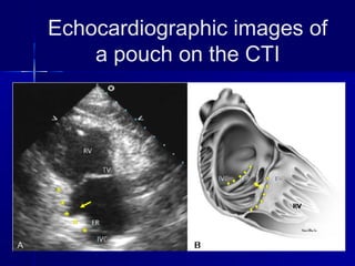Echocardiographic images of
a pouch on the CTI
 