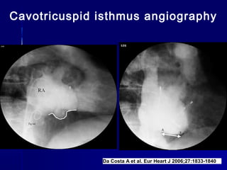 Cavotricuspid isthmus angiography
Da Costa A et al. Eur Heart J 2006;27:1833-1840
 