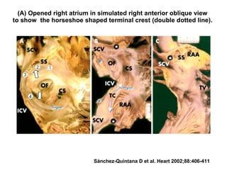 (A) Opened right atrium in simulated right anterior oblique view
to show the horseshoe shaped terminal crest (double dotted line).
Sánchez-Quintana D et al. Heart 2002;88:406-411
 