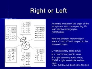 Right or LeftRight or Left
J Am Coll Cardiol. 2002;39(3):500-508.
Anatomic location of the origin of the
arrhythmia, with corresponding 12-
lead electrocardiographic
morphology.
Note the different morphology in
leads V1 and V2 with respect to the
anatomic origin.
L = left coronary aortic sinus;
N = noncoronary aortic sinus;
R = right coronary aortic sinus;
RVOT = right ventricular outflow
tract.
 