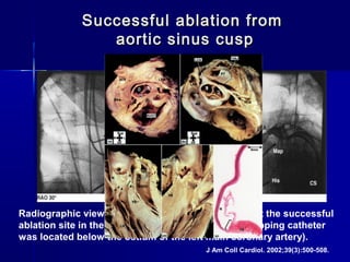J Am Coll Cardiol. 2002;39(3):500-508.
Radiographic views of the mapping catheter (Map) at the successful
ablation site in the left coronary sinus cusp. The mapping catheter
was located below the ostium of the left main coronary artery).
Successful ablation fromSuccessful ablation from
aortic sinus cuspaortic sinus cusp
 