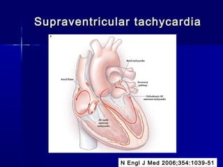 Supraventricular tachycardiaSupraventricular tachycardia
N Engl J Med 2006;354:1039-51
 