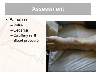 Assessment Palpation Pulse Oedema Capillary refill Blood pressure 