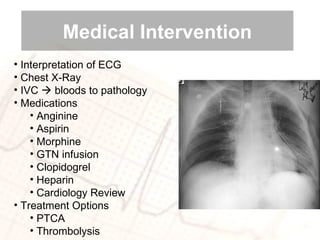 Interpretation of ECG  Chest X-Ray IVC    bloods to pathology Medications Anginine Aspirin  Morphine GTN infusion Clopidogrel Heparin Cardiology Review  Treatment Options PTCA Thrombolysis Medical Intervention 
