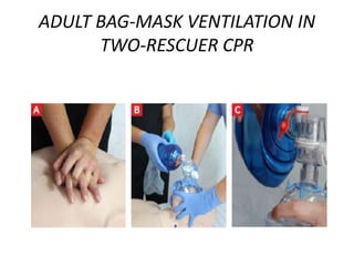 ADULT BAG-MASK VENTILATION IN
TWO-RESCUER CPR
 